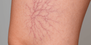 Skleroterapia w Gdyni