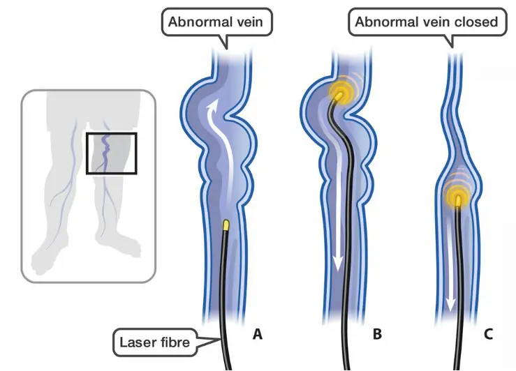 laserowe usuwanie żylaków
